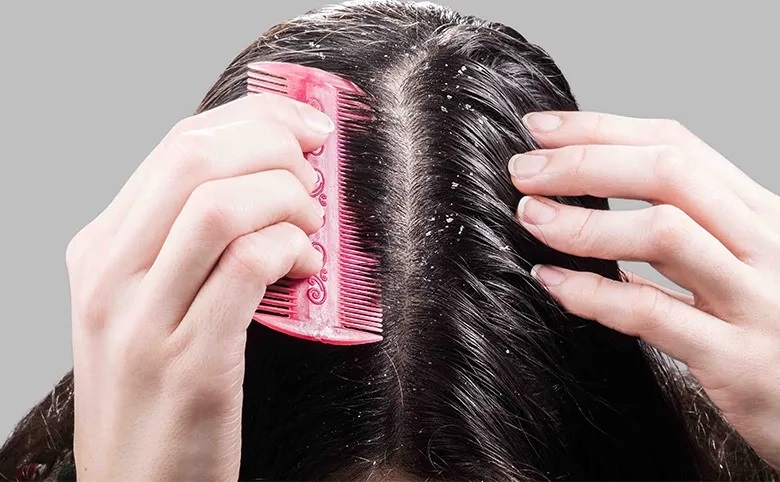 «شوره سر» درمان قطعی ندارد «شوره سر» درمان قطعی ندارد