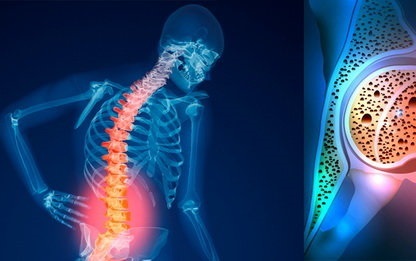 پوکی استخوان از چهزمانی شروع میشود؟ پوکی استخوان از چهزمانی شروع میشود؟