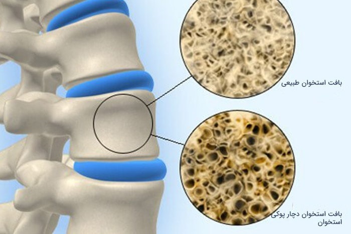 پوکی استخوان؛ بیماری خاموش، اما شایع در جامعه پوکی استخوان؛ بیماری خاموش، اما شایع در جامعه