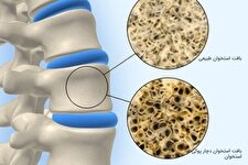 پوکی استخوان؛ بیماری خاموش، اما شایع در جامعه