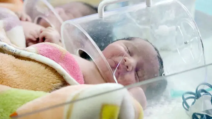 افزایش تولد نوزادان با اختلالات کروموزومی